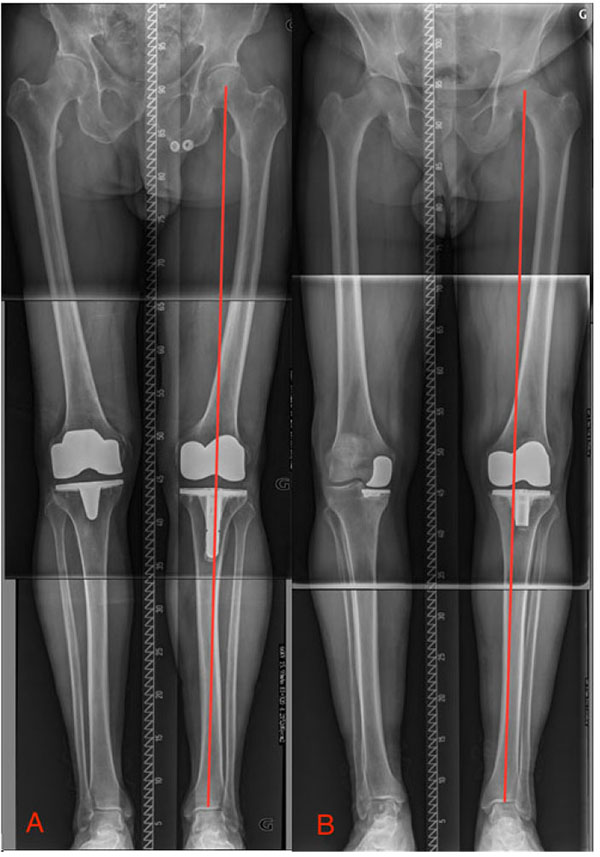 Anatomic Versus Mechanically Aligned Total Knee Arthroplasty for