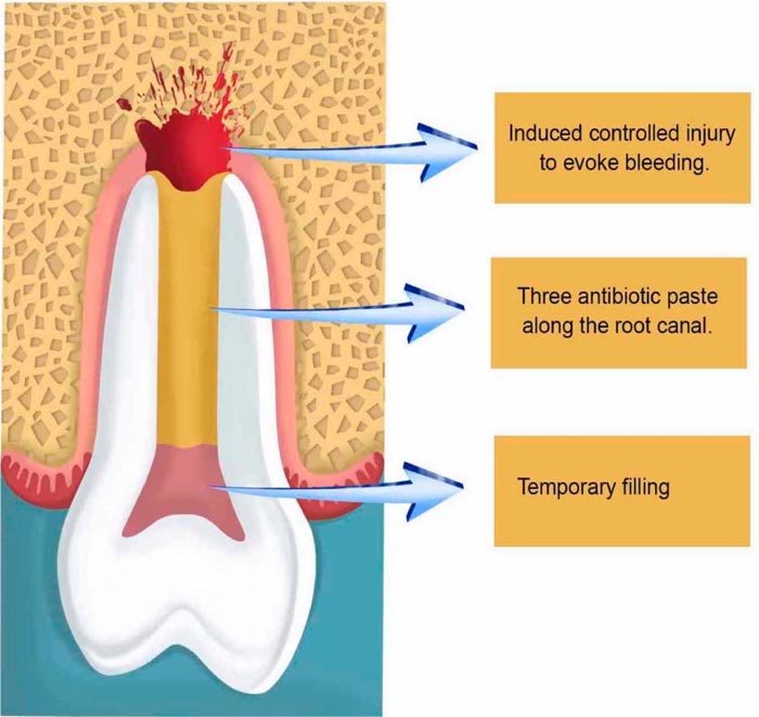 Mechanisms Involved in Apice Closure of Pulpless Teeth – Literature Review