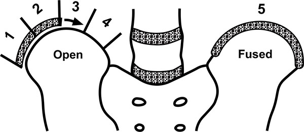 Score Riser Adolescent Idiopathic Scoliosis