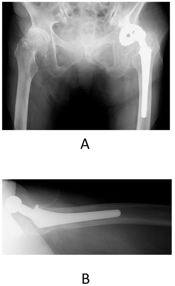 Late Anterior Dislocation Due to Posterior Pelvic Tilt in Total Hip