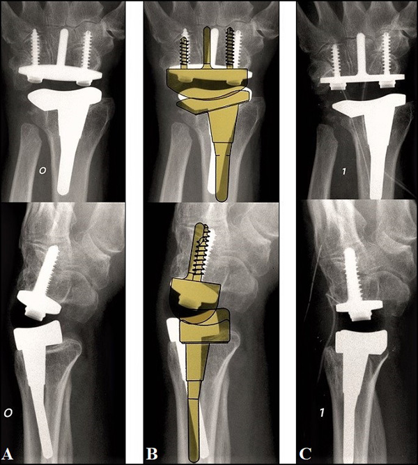 Functional After Salvage Procedures for Wrist Trauma and