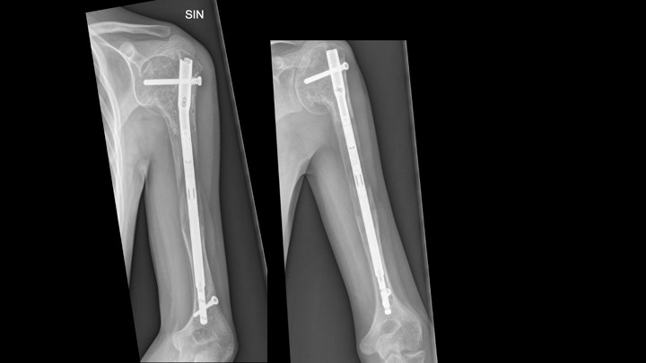 X-Ray Broken Tibia Image & Photo (Free Trial) | Bigstock