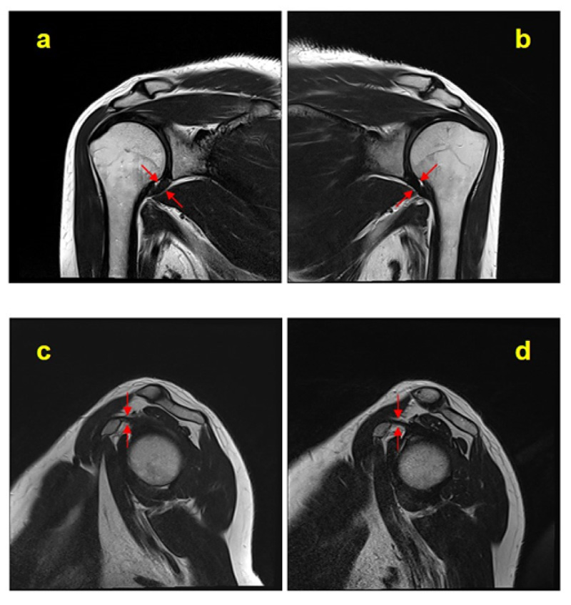 icd 10 code for mri right shoulder without contrast