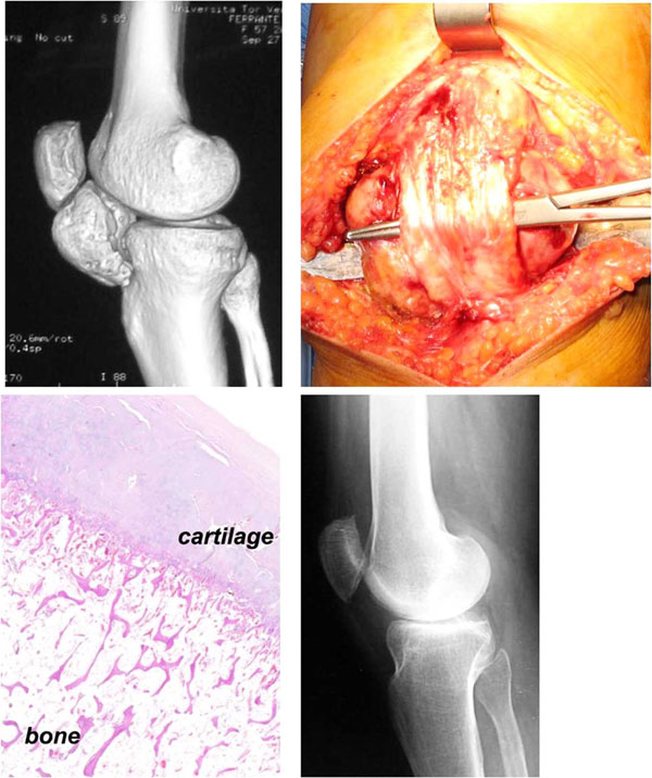 Giant Intra-Articular Extrasynovial Osteochondroma of the Knee: A Report of  Two Cases